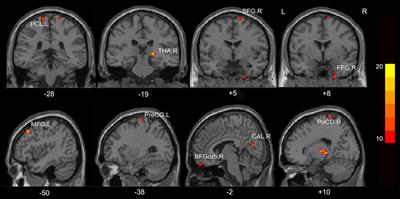 Abnormal Regional Homogeneity and Functional Connectivity of Baseline Brain Activity in Hepatitis B Virus-Related Cirrhosis With and Without Minimal Hepatic Encephalopathy